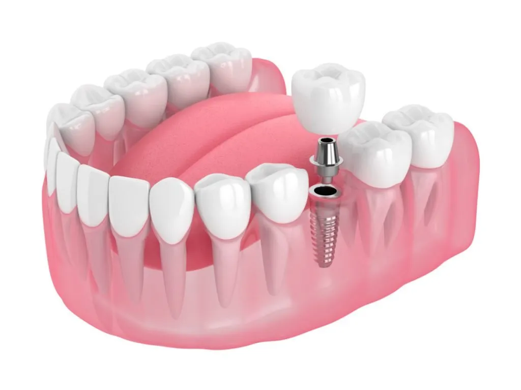 Dental implant diagram showing titanium post, abutment, and zirconia crown